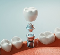 Illustration of dental implant, abutment, and crown in lower arch