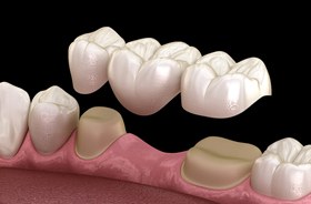 illustration of three-unit porcelain dental bridge against dark background