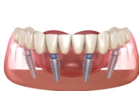 Illustration of All-on-4 implants and denture for lower arch
