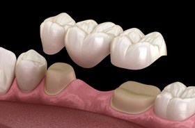 Illustration of traditional dental bridge for lower dental arch