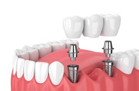 Illustration of implant bridge for lower dental arch