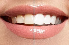 Closeup of teeth half before and half after teeth whitening