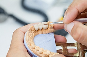 preparing a dental bridge