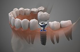 Diagram of how dental implants in Auburn are placed