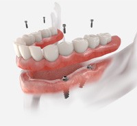 Illustration of implant dentures for lower jaw