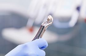 Gloved hand holding forceps after tooth extraction