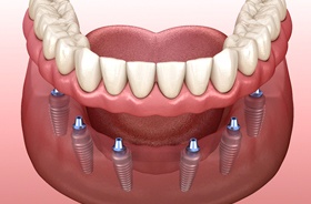 Permanent implant denture for lower arch supported by six implants