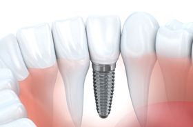 Single dental implant and crown in lower dental arch