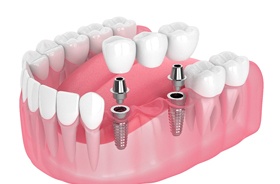 Illustration of dental implant bridge to replace three teeth