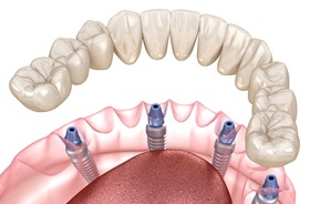 Illustration of dental implant denture for lower arch