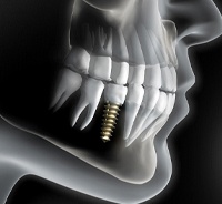 Implant in jawbone, integrated with surrounding bone tissue