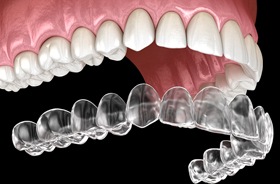 Invisalign and teeth illustration