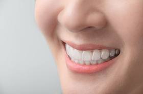 Close-up of smile wearing clear aligners