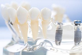 Dental implant model