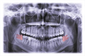 Wisdom teeth x-ray