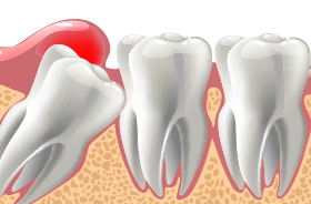 Graphic of impacted wisdom tooth