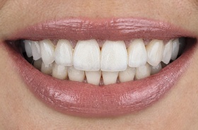 Close-up of woman’s smile with veneers in Auburn