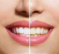 Woman’s teeth before and after whitening treatment