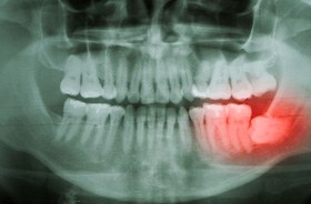 X-ray with impacted wisdom tooth highlighted in red