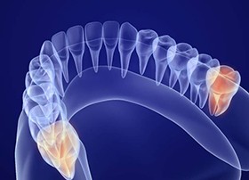 wisdom teeth illustration