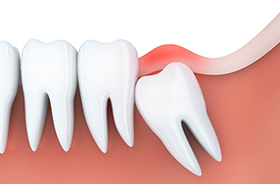 Graphic of wisdom tooth