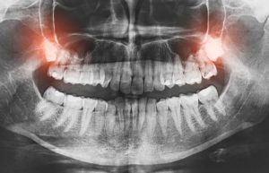 X-ray of impacted teeth, causing wisdom tooth pain