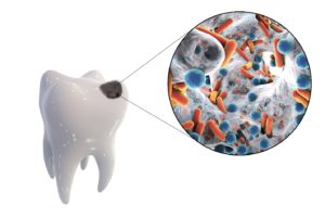 Illustration of a cavity that could cause tooth pain