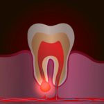 Infected tooth, may cause major toothache in Auburn