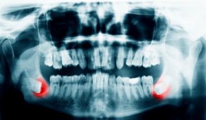 X-ray showing impacted wisdom teeth