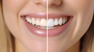Close-up of woman’s smile before and after teeth whitening
